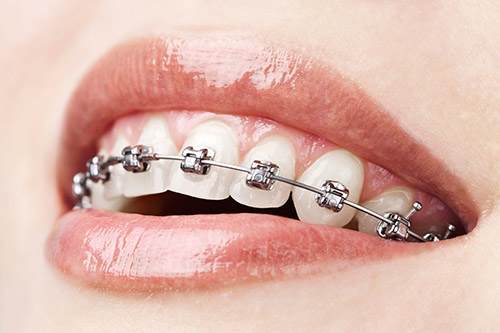 braces (1)